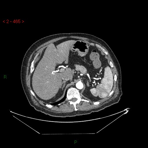 File:Circumaortic left renal vein and doubled left renal arteries (Radiopaedia 52268-58158 A 1).jpg