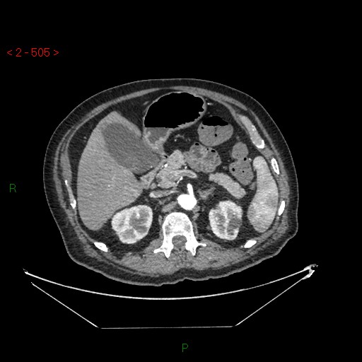 Circumaortic left renal vein and doubled left renal arteries (Radiopaedia 52268-58158 A 41).jpg