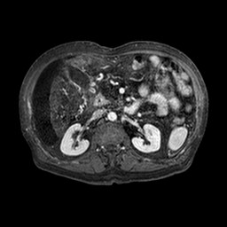 File:Cirrhosis and hepatocellular carcinoma in the setting of hemochromatosis (Radiopaedia 75394-86594 Axial T1 C+ fat sat 195).jpg