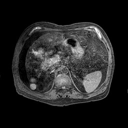 Cirrhosis and hepatocellular carcinoma in the setting of hemochromatosis (Radiopaedia 75394-86594 Axial T1 C+ fat sat 44).jpg