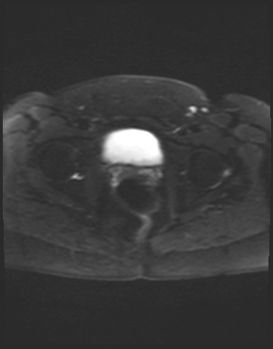 Class II Mullerian duct anomaly- unicornuate uterus with rudimentary horn and non-communicating cavity (Radiopaedia 39441-41755 Axial DWI 22).jpg