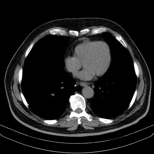 File:Classic complicated silicosis (Radiopaedia 49720-54961 Axial liver window 37).jpg