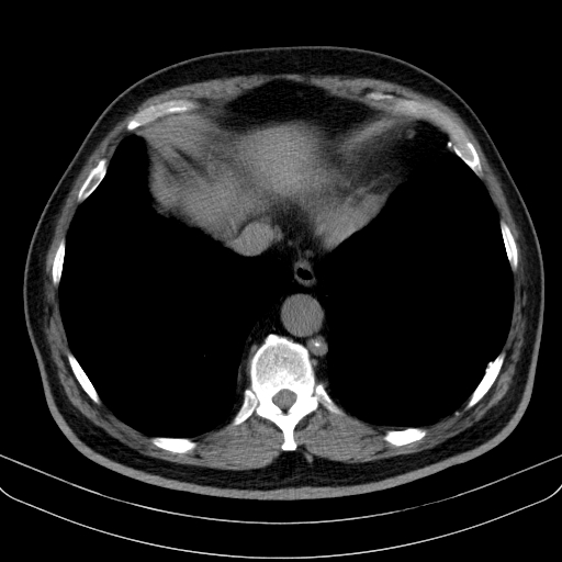 File:Classic complicated silicosis (Radiopaedia 49720-54961 Axial liver window 45).jpg