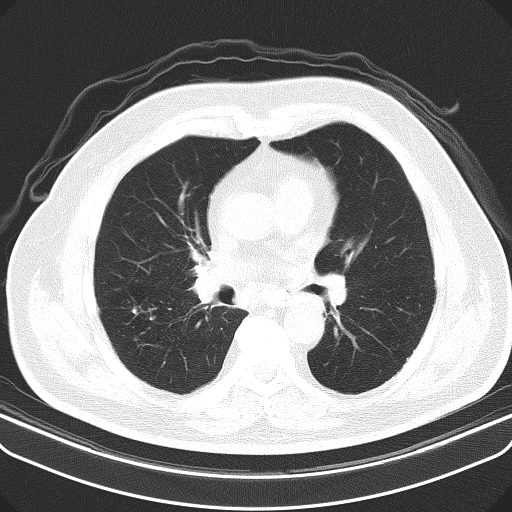 Classic complicated silicosis (Radiopaedia 49720-54961 Axial lung window 28).jpg