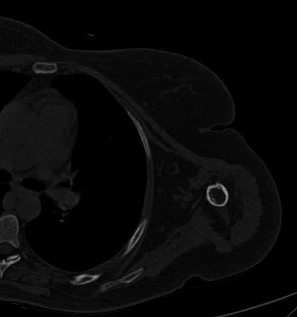 Clear cell chondrosarcoma - humerus (Radiopaedia 63104-71612 Axial bone window 76).jpg