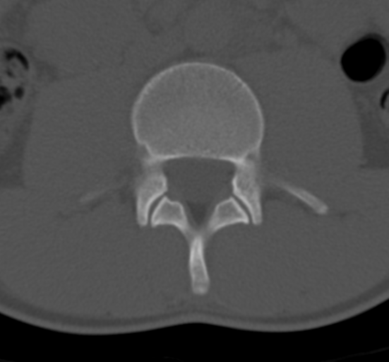 Clear cell meningoma - lumbar spine (Radiopaedia 60116-67691 Axial bone window 35).png