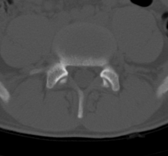 Clear cell meningoma - lumbar spine (Radiopaedia 60116-67691 Axial bone window 57).png