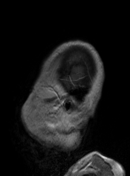 Clival meningioma (Radiopaedia 53278-59248 Sagittal T1 C+ 132).jpg