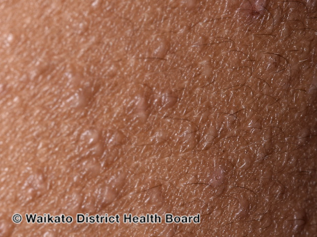 File:Close up of follicular eczema (DermNet NZ atopic-dermatitis-2).jpg