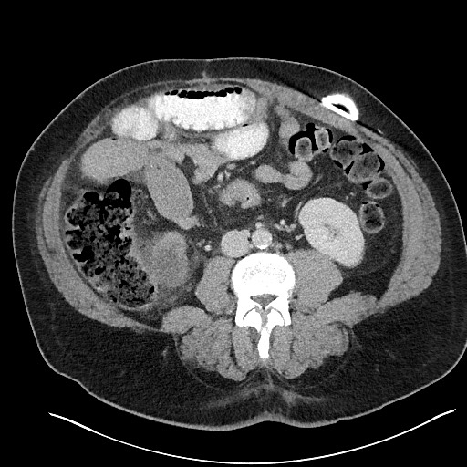 File:Closed loop obstruction - internal hernia into nephrectomy bed (Radiopaedia 59867-67320 Axial 18).jpg