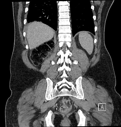 Closed loop obstruction - internal hernia into nephrectomy bed (Radiopaedia 59867-67320 B 111).jpg