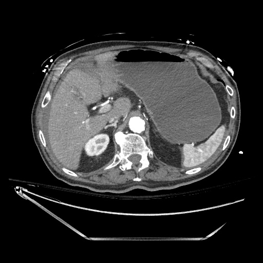 File:Closed loop obstruction due to adhesive band, resulting in small bowel ischemia and resection (Radiopaedia 83835-99023 Axial 309).jpg