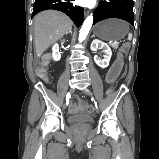 File:Closed loop obstruction due to adhesive band, resulting in small bowel ischemia and resection (Radiopaedia 83835-99023 C 74).jpg