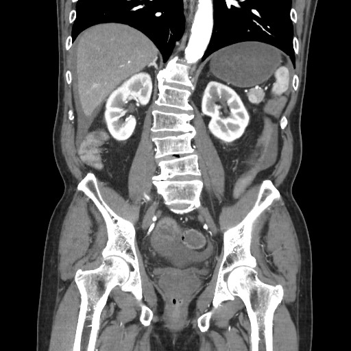 File:Closed loop obstruction due to adhesive band, resulting in small bowel ischemia and resection (Radiopaedia 83835-99023 C 80).jpg