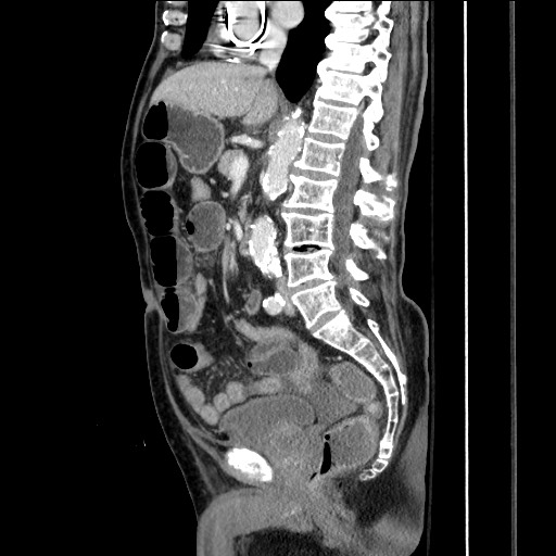 File:Closed loop obstruction due to adhesive band, resulting in small bowel ischemia and resection (Radiopaedia 83835-99023 F 95).jpg