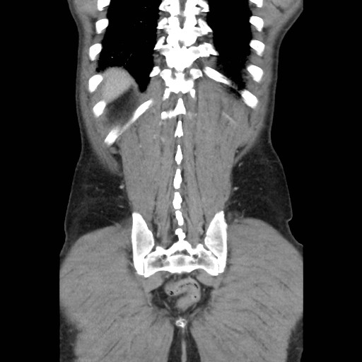 File:Closed loop small bowel obstruction (Radiopaedia 59227-66554 B 43).jpg