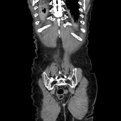 File:Closed loop small bowel obstruction - adhesive disease and hemorrhagic ischemia (Radiopaedia 86831-102990 B 114).jpg