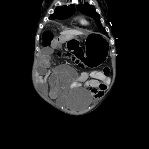 Closed loop small bowel obstruction - adhesive disease and hemorrhagic ischemia (Radiopaedia 86831-102990 B 31).jpg