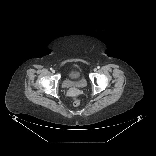 Closed loop small bowel obstruction - internal hernia (Radiopaedia 65402-74450 A 125).jpg