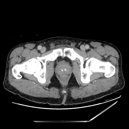 Closed loop small bowel obstruction - omental adhesion causing "internal hernia" (Radiopaedia 85129-100682 A 169).jpg