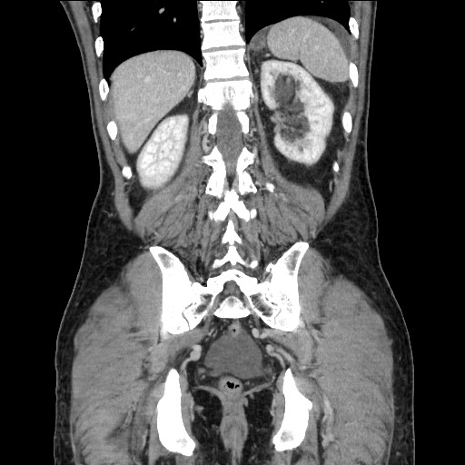 File:Closed loop small bowel obstruction - omental adhesion causing "internal hernia" (Radiopaedia 85129-100682 B 97).jpg