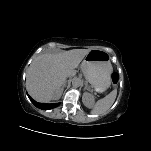 File:Closed loop small bowel obstruction due to adhesive band, with intramural hemorrhage and ischemia (Radiopaedia 83831-99017 Axial non-contrast 43).jpg
