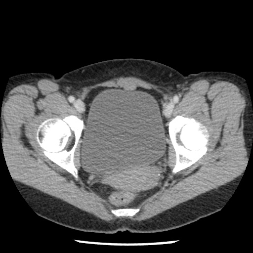 Closed loop small bowel obstruction due to trans-omental herniation (Radiopaedia 35593-37109 A 80).jpg
