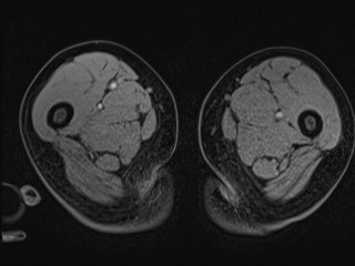 File:Closed loop small bowel obstruction in pregnancy (MRI) (Radiopaedia 87637-104031 G 56).jpg