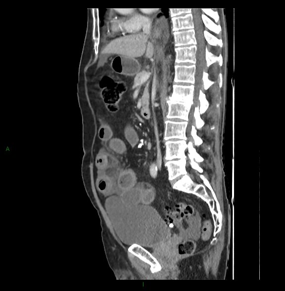 File:Closed loop small bowel obstruction with ischemia (Radiopaedia 84180-99456 C 45).jpg