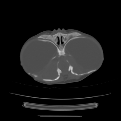 Cloverleaf skull (Radiopaedia 91901-109710 Axial bone window 54).jpg