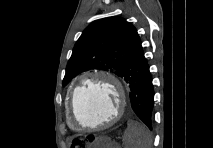 Coarctation of aorta with aortic valve stenosis (Radiopaedia 70463-80574 B 184).jpg