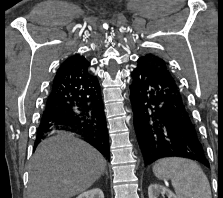 Coarctation of the aorta (Radiopaedia 53752-59822 B 62).jpg