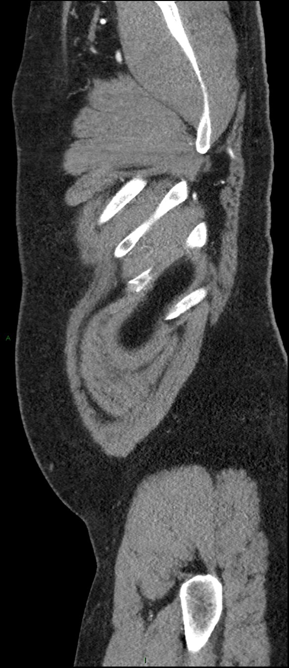 Coarctation of the aorta (Radiopaedia 74632-88521 C 13).jpg