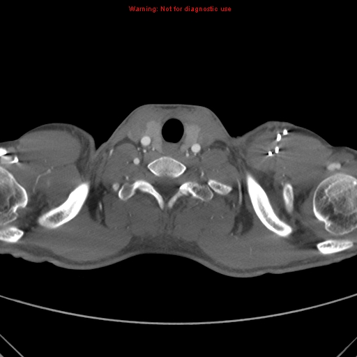 File:Coarctation of the aorta (Radiopaedia 9434-10118 A 1).jpg