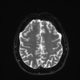 Cochlear incomplete partition type III associated with hypothalamic hamartoma (Radiopaedia 88756-105498 Axial DWI 31).jpg