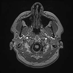 File:Cochlear incomplete partition type III associated with hypothalamic hamartoma (Radiopaedia 88756-105498 Axial T1 29).jpg