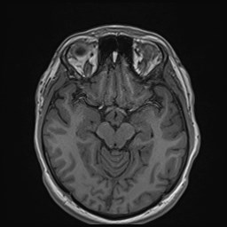 File:Cochlear incomplete partition type III associated with hypothalamic hamartoma (Radiopaedia 88756-105498 Axial T1 88).jpg