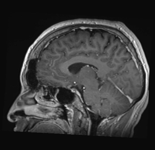 Cochlear incomplete partition type III associated with hypothalamic hamartoma (Radiopaedia 88756-105498 Sagittal T1 C+ 25).jpg