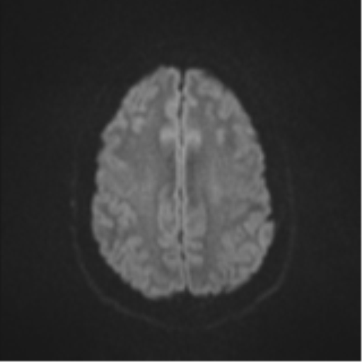 Colloid cyst (Radiopaedia 53164-59125 Axial DWI 49).png