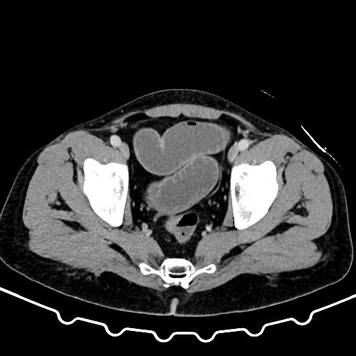 File:Colocolic intussusception due to large lipoma (Radiopaedia 68773-78482 A 171).jpg