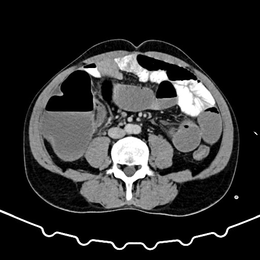 File:Colocolic intussusception due to large lipoma (Radiopaedia 68773-78482 Axial 111).jpg