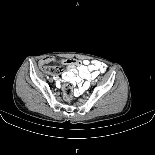 Colon adenocarcinoma - hepatic flexure (Radiopaedia 85635-101395 A 79).jpg