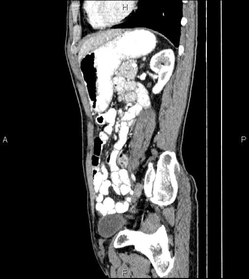 Colon adenocarcinoma - hepatic flexure (Radiopaedia 85635-101395 D 61).jpg