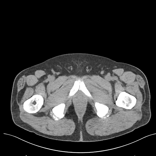 File:Colon adenocarcinoma - splenic flexure (Radiopaedia 34143-35406 Axial Oral contrast 93).png