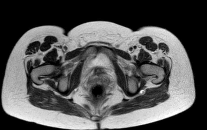 Colon adenocarcinoma with Krukenberg tumors, advanced pregnancy (Radiopaedia 67279-76645 Axial T2 4).jpg