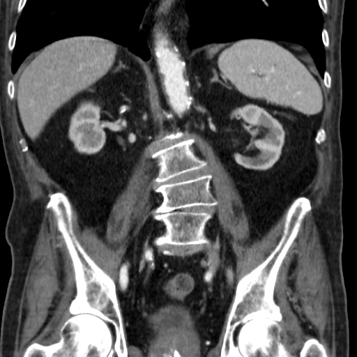 File:Colon cancer with duodenal invasion (Radiopaedia 16278-15958 B 38).jpg