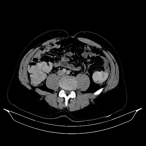Colonic diverticulosis (Radiopaedia 72222-82744 A 52).jpg