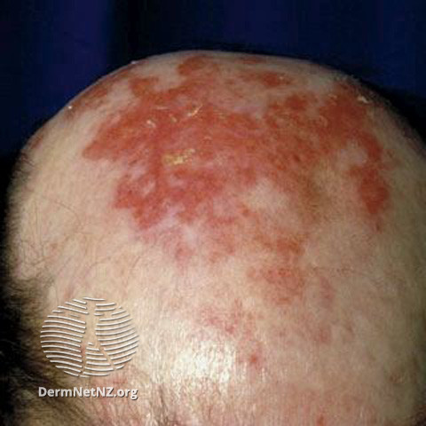 Cutaneous lupus erythematosus (DermNet NZ immune-lupus-erythematosus-2518).jpg