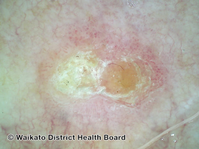 File:Intraepidermal carcinoma, nonpolarised dermoscopy view (DermNet NZ 111488-v2).jpg