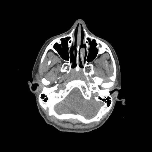 Nasal pyogenic granuloma (lobular capillary hemangioma) (Radiopaedia 85536-101244 Axial non-contrast 64).jpg